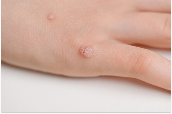 Mole Removal for All Ages: Is It Safe?